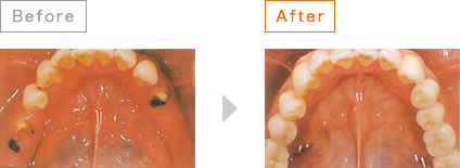 インプラント治療（臼歯（奥の歯）を失った場合）